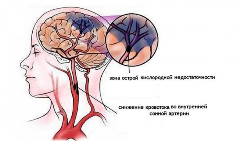 Последствия недостатка поступления кислорода в головной мозг: причины, симптомы и лечение