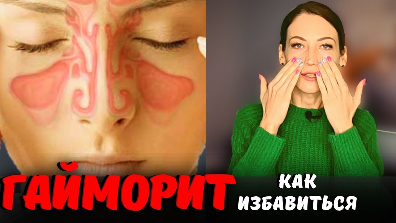 ГАЙМОРИТ - как избавиться. Психосоматика гайморита.